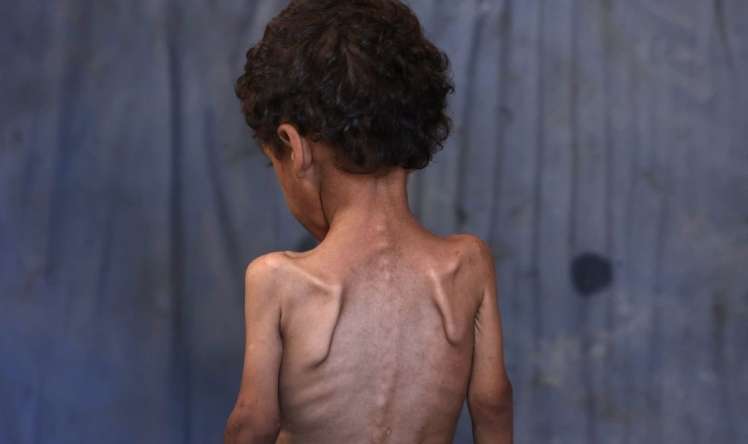 Səhiyyə çöküb,  uşaqlar aclıqdan ölür... - FOTO