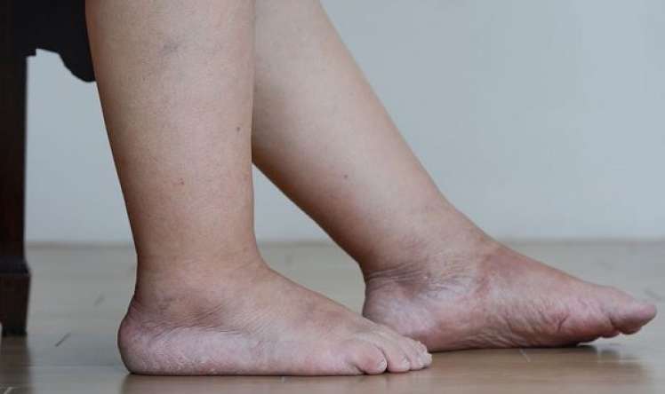 Bədəndə şişkinlik bu 3 səbəbdən ola bilər     – Kardioloq xəbərdarlıq edir