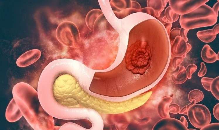  Bu vitamin çatışmayanda  – mədədə xərçəng yaranır