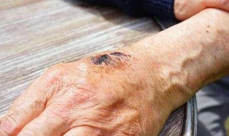 Azərbaycanda qarayaraya  yoluxanların sayı artıb