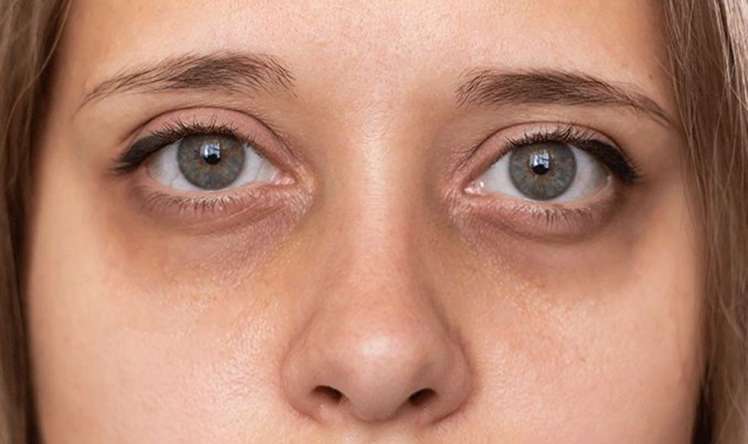 Gözaltı göyərmə və qaraltılar  – Hansı xəstəlikdən xəbər verir?