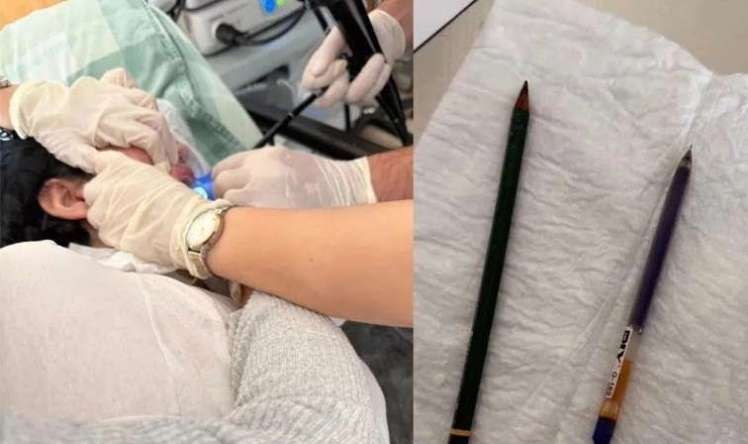 22 yaşlı xəstənin mədəsindən 2 qələm çıxarıldı -  FOTO