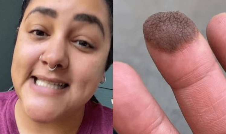 Dəri transplantasiyası olan qızın barmağından     tüklər çıxdı