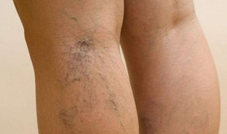 Varikoz damarlarını artıran içki -  Hamı içir