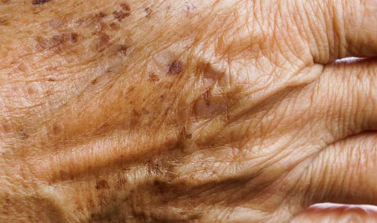 Gündə bir dəfə sürtün -  Qocalıq ləkələrini yox edir