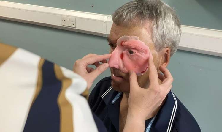 Üzü dağılmış kişini 3D printerlə bərpa etdilər 