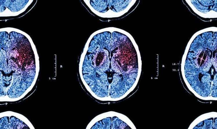 İnsultlar daha çox 55 yaşdan    aşağı qruplarda olur