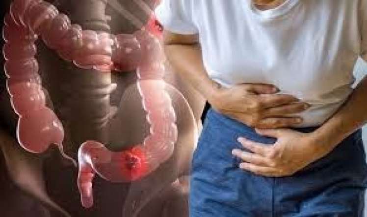 Bu cür qidalanma yoğun bağırsaq şişləri yaradır 