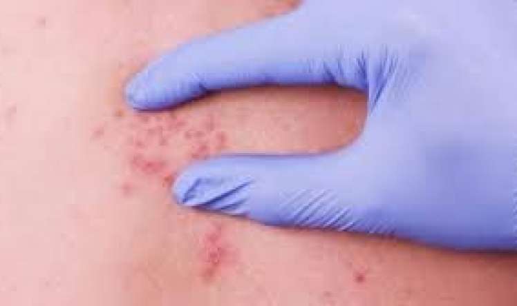 Bədəninizdə parazit olub-olmadığını evdə necə bilməli? 