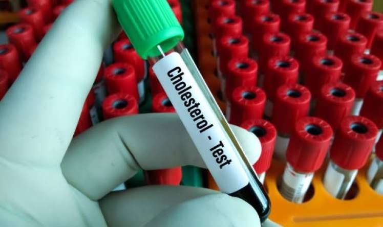 Xolesterol haqqında gözardı olunmamalı  – 4 əsas fakt