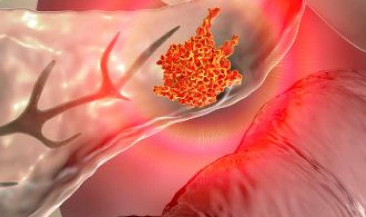 Mədəaltı vəz xərçəngi uzun qızdırma ilə başlaya bilər 