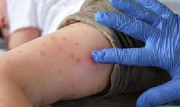 Çikunqaya qızdırması yayılır 