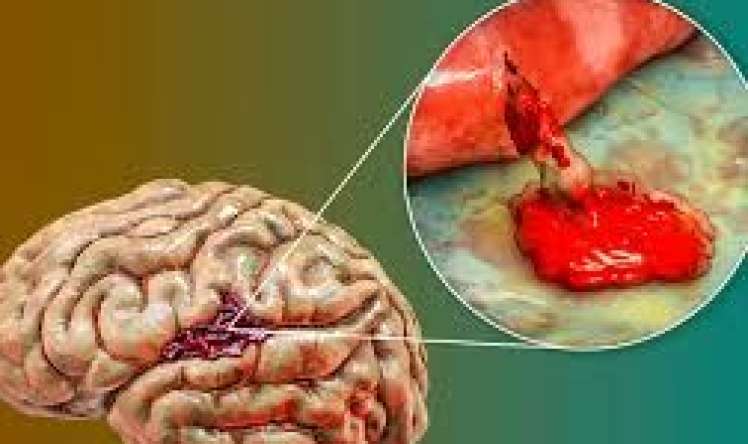 İnsultdan 1 həftə əvvəl hansı işarələr olur? 