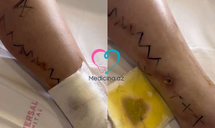 Daha bir qadın estetik prosedurun qurbanı oldu -  VİDEO