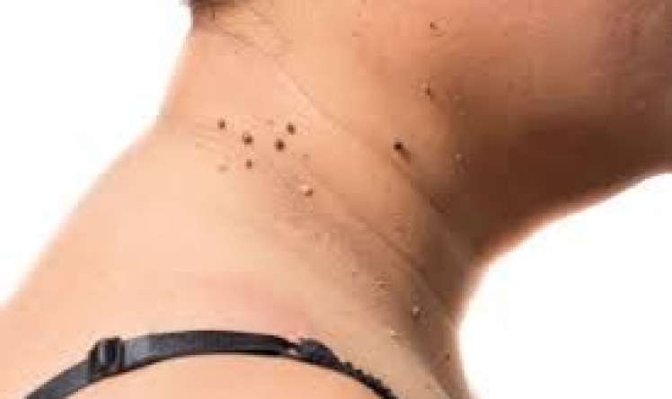 Papillomavirusların törətdiyi xəstəliklər və müalicəsi  - OMELOTERAPİYA  