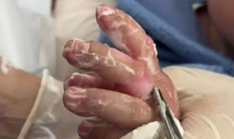 10 aylıq körpə yanıq xəsarəti aldı -  Əlini qaynar çaydana salıb... - VİDEO