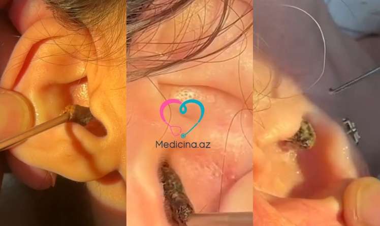 Qulağı pambıq çubuqlarla təmizləməyin nəticəsi -  Həkimdən xəbərdarlıq-VİDEO
