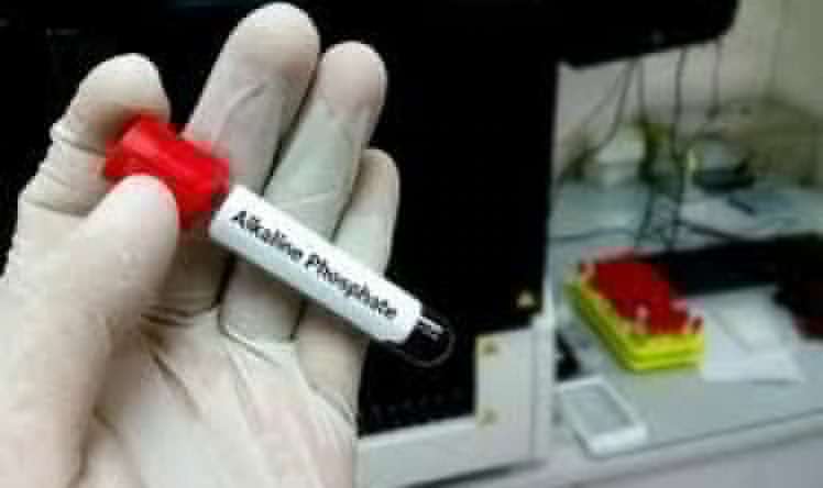 Ümumi qan analizi gizli sümük xəstəliyini göstərir 