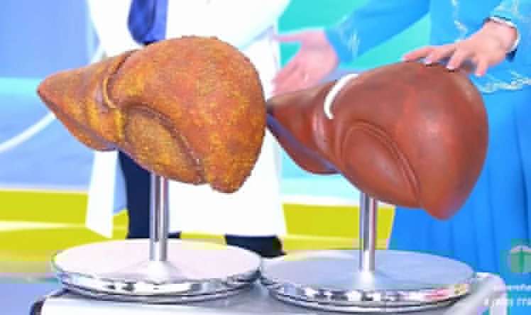 Kimin qaraciyərini araq tez sıradan çıxarır? 