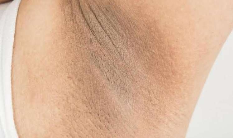 Qolaltı qaralmalar -  Necə xilas ola bilərik? - Həkimdən açıqlama