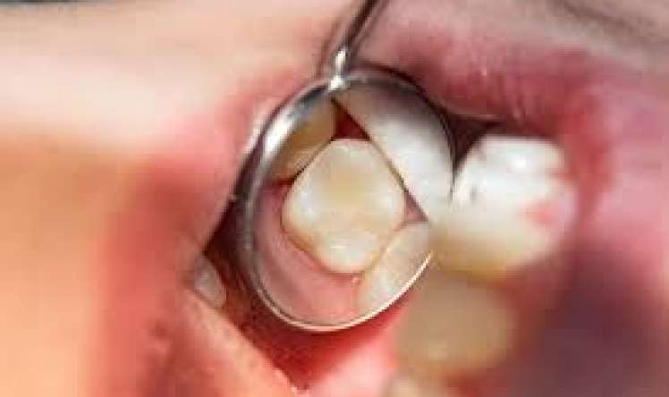  Çox saqqız çeynəmək dişlərdəki plombları boşaldır 