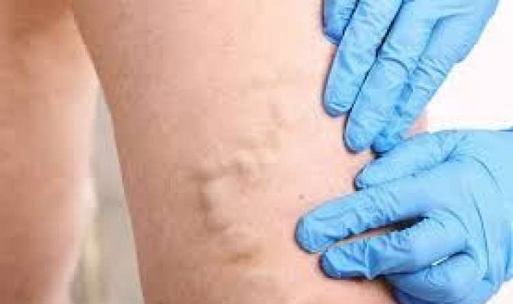  Ayaqlarda tromblar - Necə bilinir?