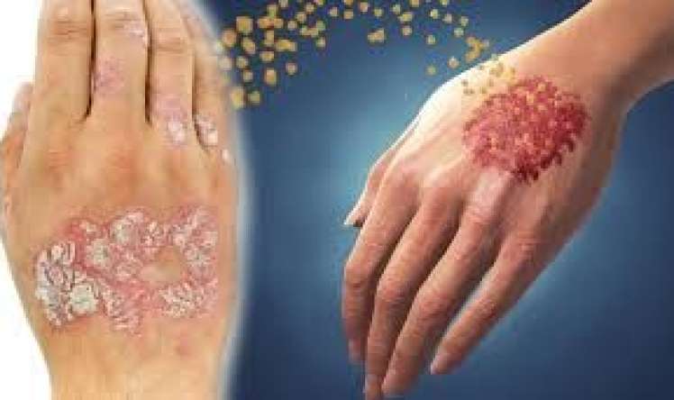 Psoriaz və ya pullu dəmrov - Niyə tam sağalmır?