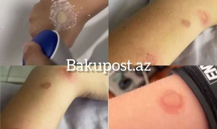 Gənclər özlərini yandırır – Sosial şəbəkələrdə qorxunc trend -  Deodorant Challenge - VİDEO