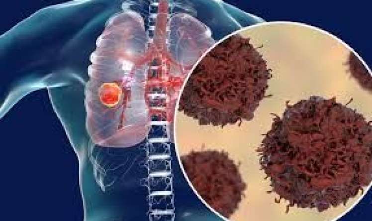 Kişilərdə ağciyər xərçəngi birinci yerdədir, səbəbi...  - Onkoloq  Vüsalə Tağıyeva