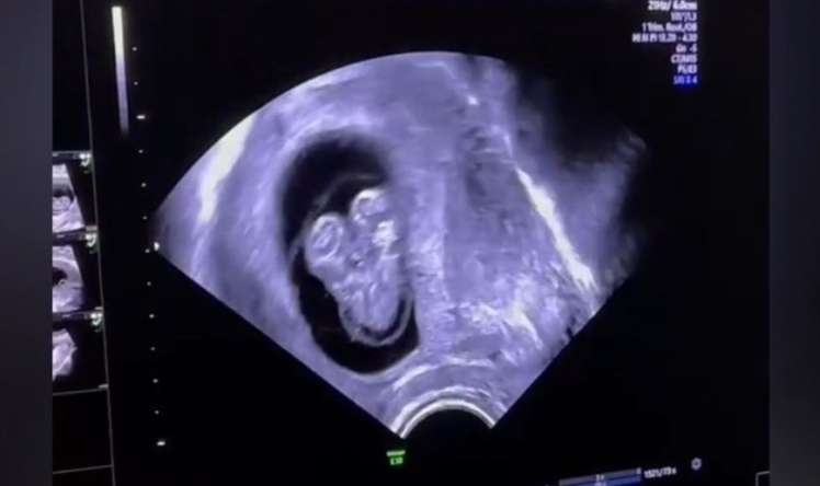 Azərbaycanda hamilədə Siam əkizləri görüldü - Video