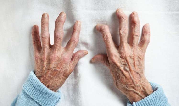  Revmatoid artritin ən erkən  – 7 ƏLAMƏTİ