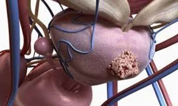 Kişilərdə bu aqressiv xərçəng genetikdir 