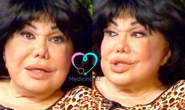 Flora Kərimovanın üzünə nə olub? -  "Yaxşı deyiləm" - VİDEO