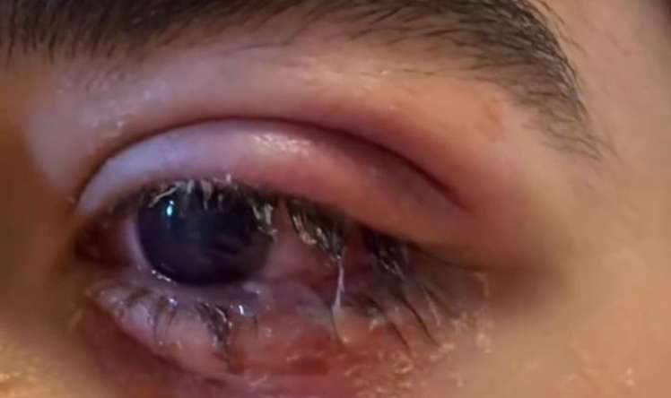 "Partladan" partlatdı - Gözü zədələndi -  VİDEO