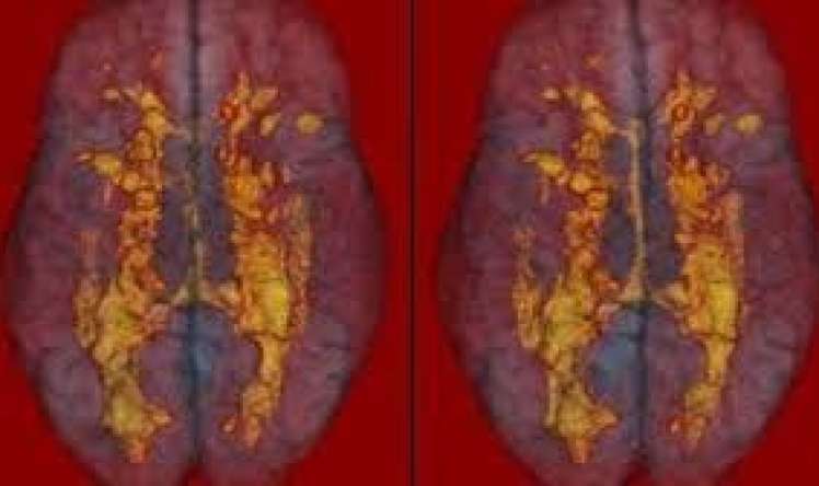 Balıq insulta səbəb ola bilərmi? 