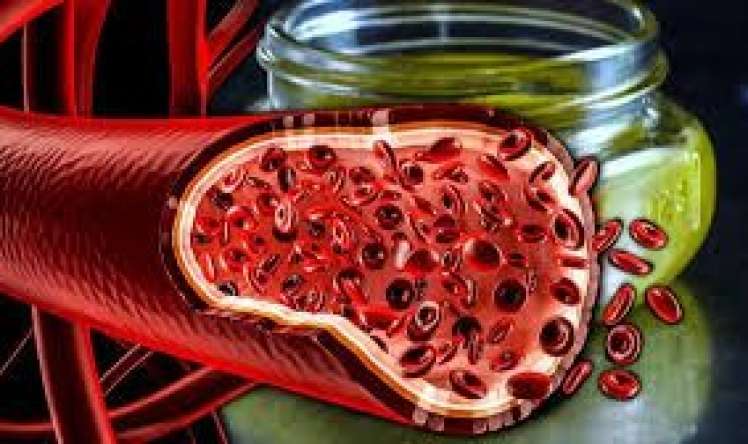 Damarları təmizləmək təhlükəlidir 