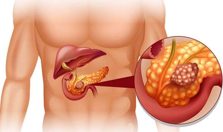 Kəskin pankreatitdə  yüksəkdozalı vitamin C   -   sağalmanmı sürətləndirir