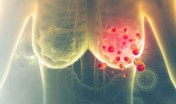 Süd vəzi xərçəngi xəstələrində   -  Venadaxili vitamin C-nin təsiri