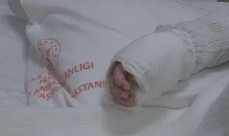 Körpənin üstünə qaynar su töküldü:  Bədəninin 27%-i yandı 