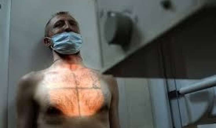 İngiltərədə vərəmdə kəskin artım 