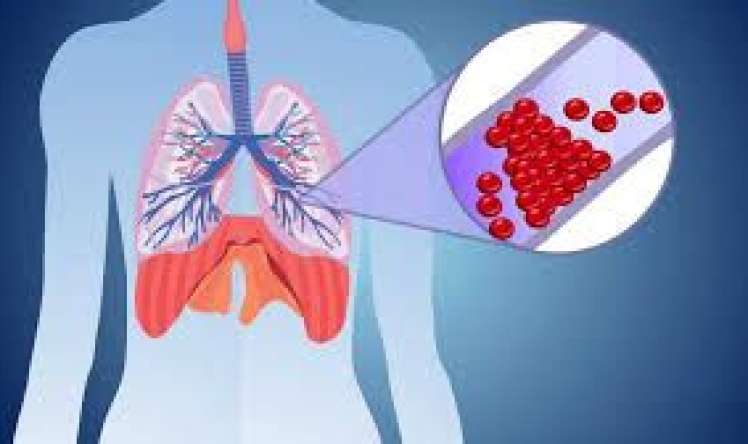 Ağciyər emboliyasını müalicəsi  edən cihaz    - kəşf edildi