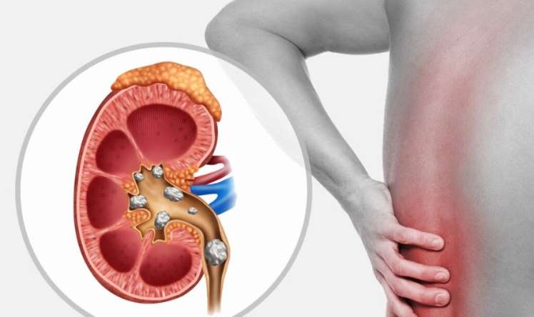 Hər gün bir ovuc yeyin:  Böyrək daşlarını atmağa kömək edir