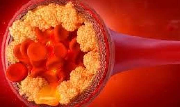 Pis" xolesterolu 60% azaldan dərman kəşf edildi 