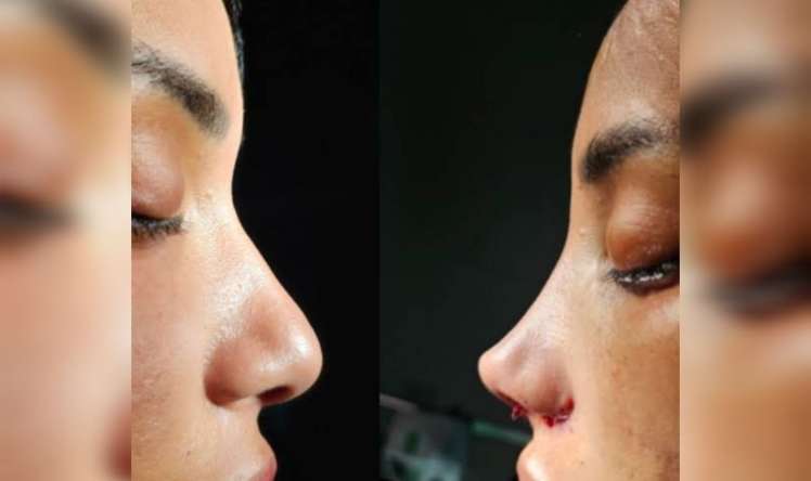 Ən təhlükəli burun trendi -  "Barbie nose"