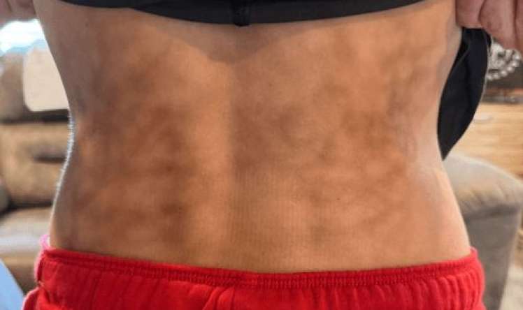 “Qrelkaya” olan sevgisindən bədəni    bu hala düşdü