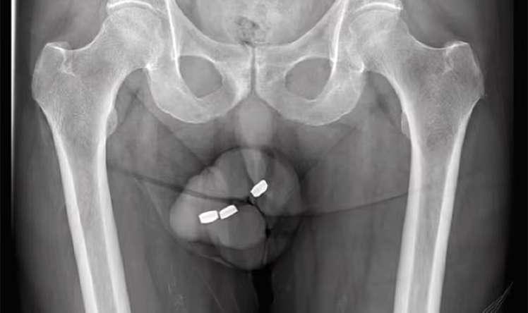 Penisində batareya ilişib qalan kişi     -  əməliyyat olundu