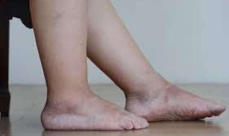 Ayaqda şişin ürəklə əlaqə olduğunu necə  bilək? 