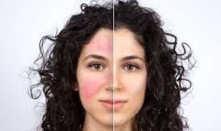 Üzün qızarması bədəndən gələn siqnaldır   - 12 səbəb