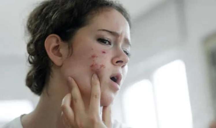 Gecə dəri baxımında  edilən səhv -  Sızanaqlara səbəb olur