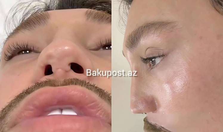 4 dəfə uğursuz əməliyyat etdirən stilist   - Həkimləri ifşa etdi - Adlar